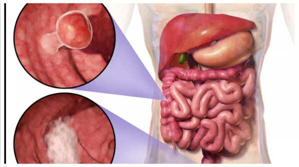 Illustration of blood in stool.