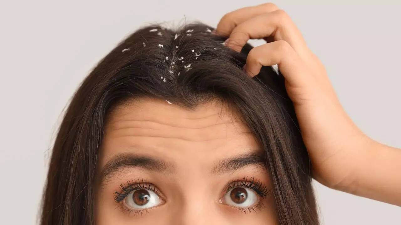 Signs that you have sticky, oily dandruff